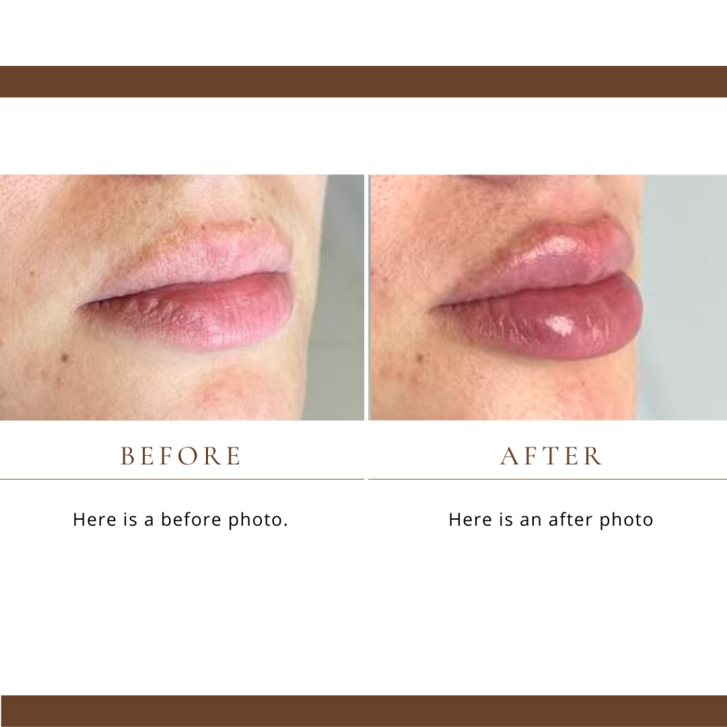 Dermal Fillers for Lip Injections